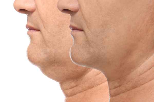 HIFU - Breakthrough in Anti - ageing 2 hifu results West Malling