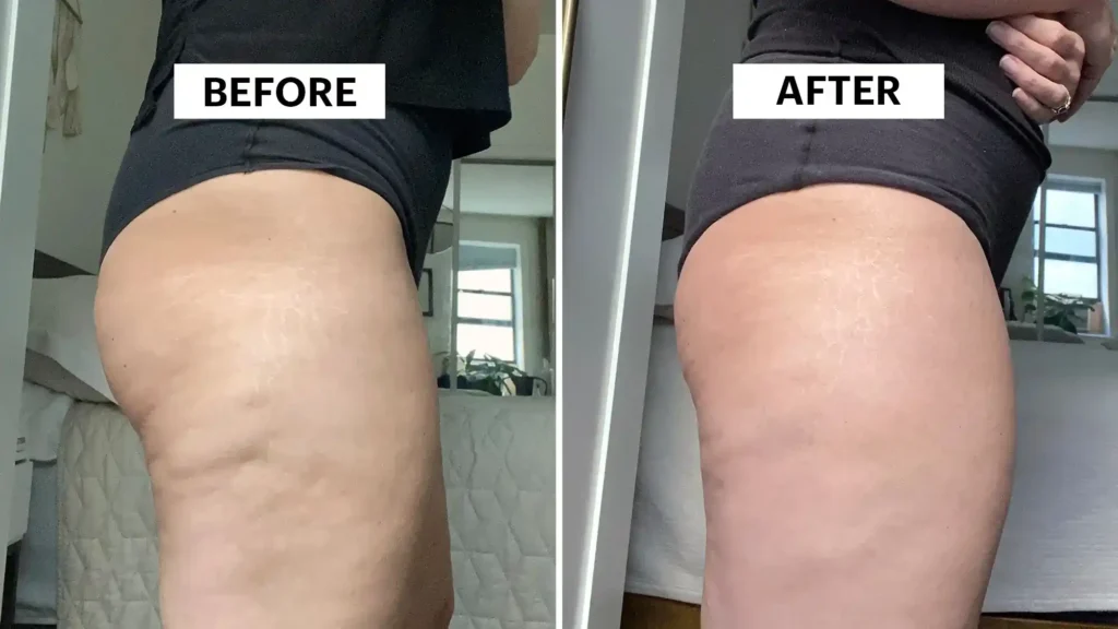 Sculpting Your Bum: Can Toning Exercises Really Reduce Cellulite? 1 Do Toning Exercise West Malling Really Tackle Cellulite?