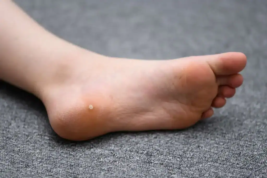 Cryotherapy For Warts And Also Verrucas 2 Image of verruca on the bottom of the foot that able to be treated with Cryotherapy West Malling