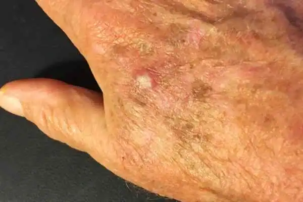 Image of Actinic keratoses West Malling on a person hand