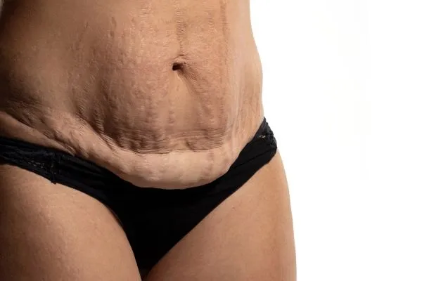The Science of Skin Tightening 1 The science behind skin tightening West Malling picture of a woman's sagging skin on the stomach